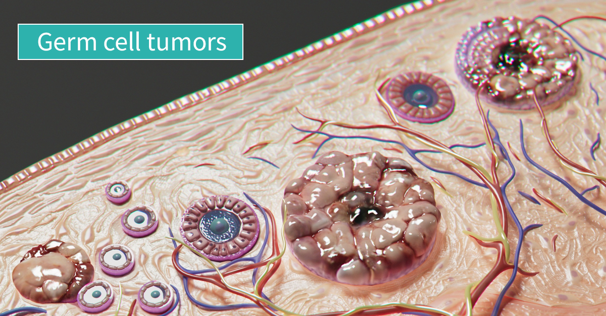 Germ cell tumor