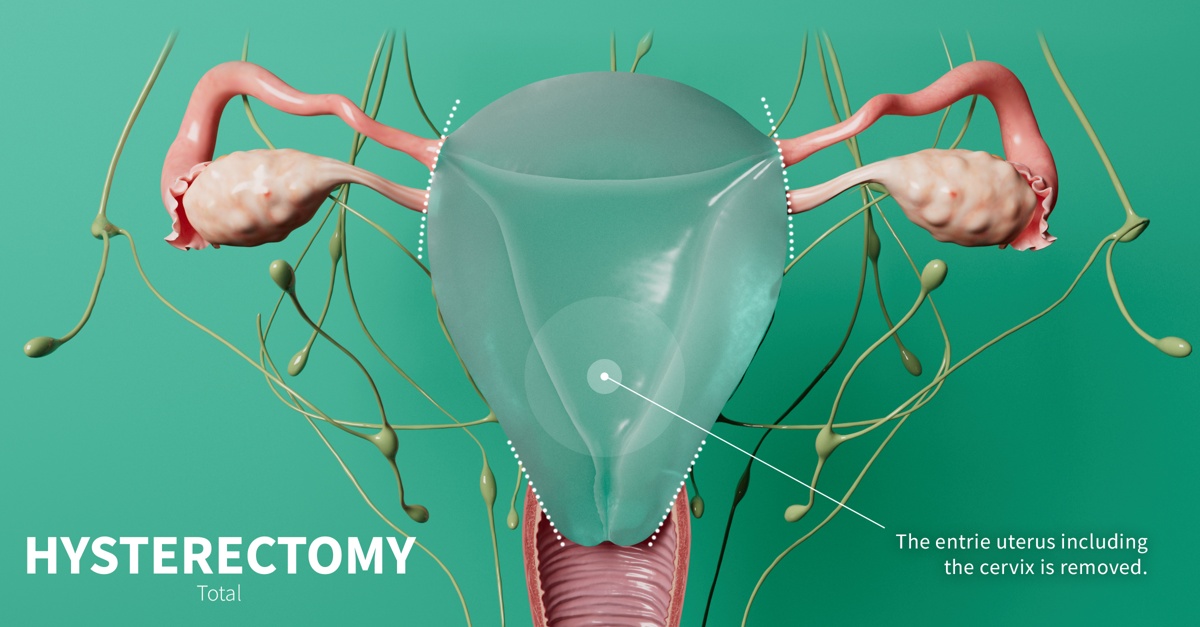 Types Of Hysterectomy Complete Anatomy 