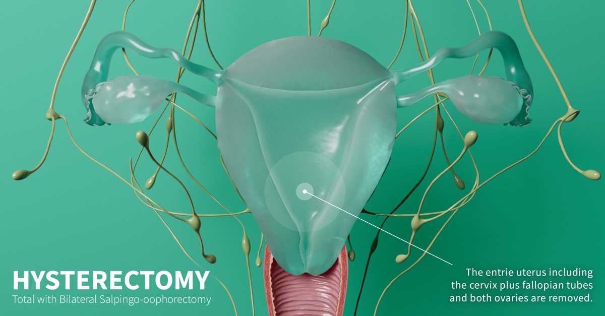 Total hysterectomy with bilateral salpingo-oophorectomy