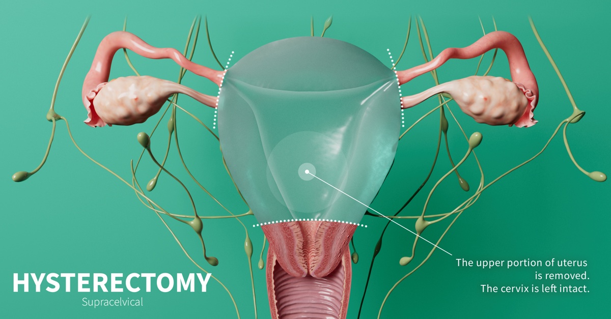 Supracervical hysterectomy