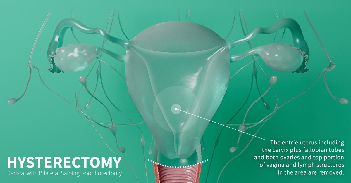 Radical hysterectomy with bilateral salpingo-oophorectomy