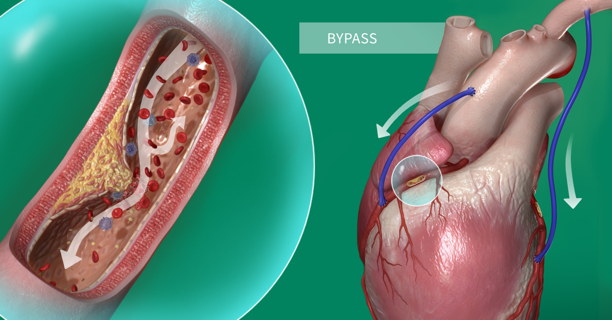 Heart Artery Bypass Coronary Artery Bypass Surgery Wikipedia