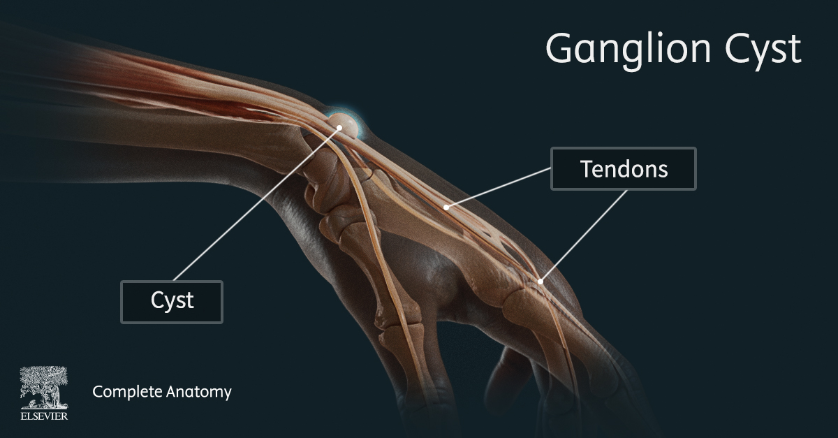 Image showing the wrist with the skin faded to reveal the bones, muscles, tendons and ganglion cyst beneath.