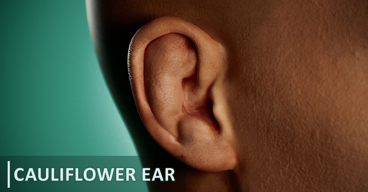 Learn more about the anatomy of cauliflower ear